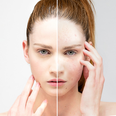 Pluryal Mesoline: before and after skin revitalisation